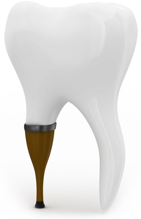 Protetyka stomatologiczna w Bianco Stomatologia Tychy - korony, mosty, protezy i inne uzupełnienia protetyczne